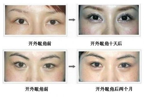 怎么开眼角?