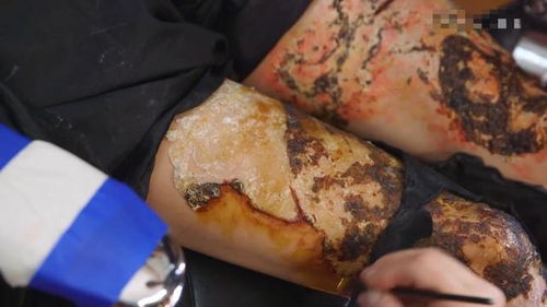 烧伤具体的级别