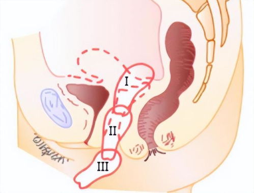 脱肛阴挺是什么意思，阴挺是什么意思足厥阴肝经的五输