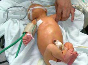 无肛造瘘手术是什么意思，无肛门婴儿能治好吗