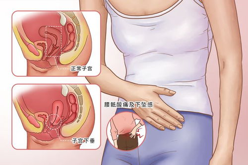 阴挺是什么意思