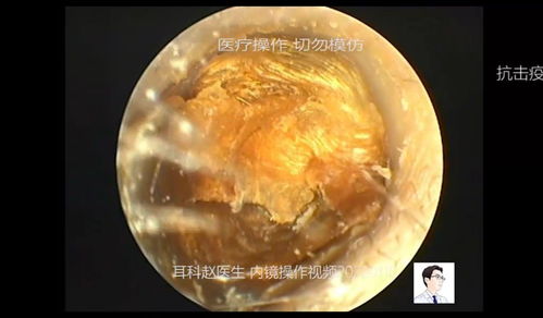 耵聍的读音耵聍的读音是什么